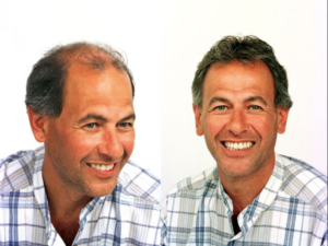 Before & After Hair Loss Treatment