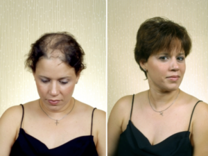 Before & After Hair Replacement For Women