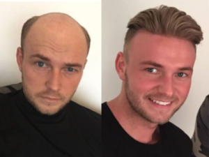 Before & After Hair Extensions For Men