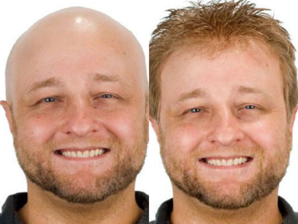 Before & After Hair Loss Treatment For Men